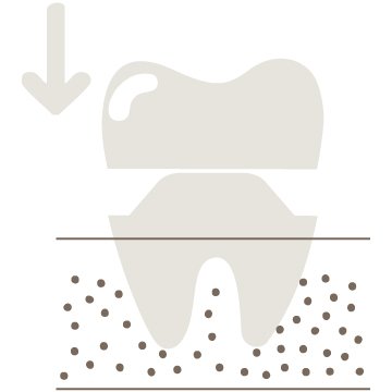 Crowns