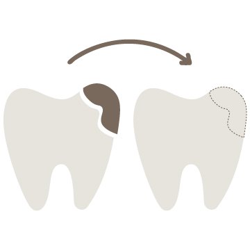 Fillings