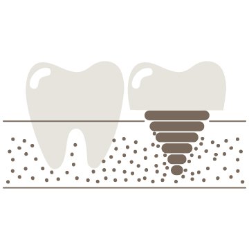 Implants