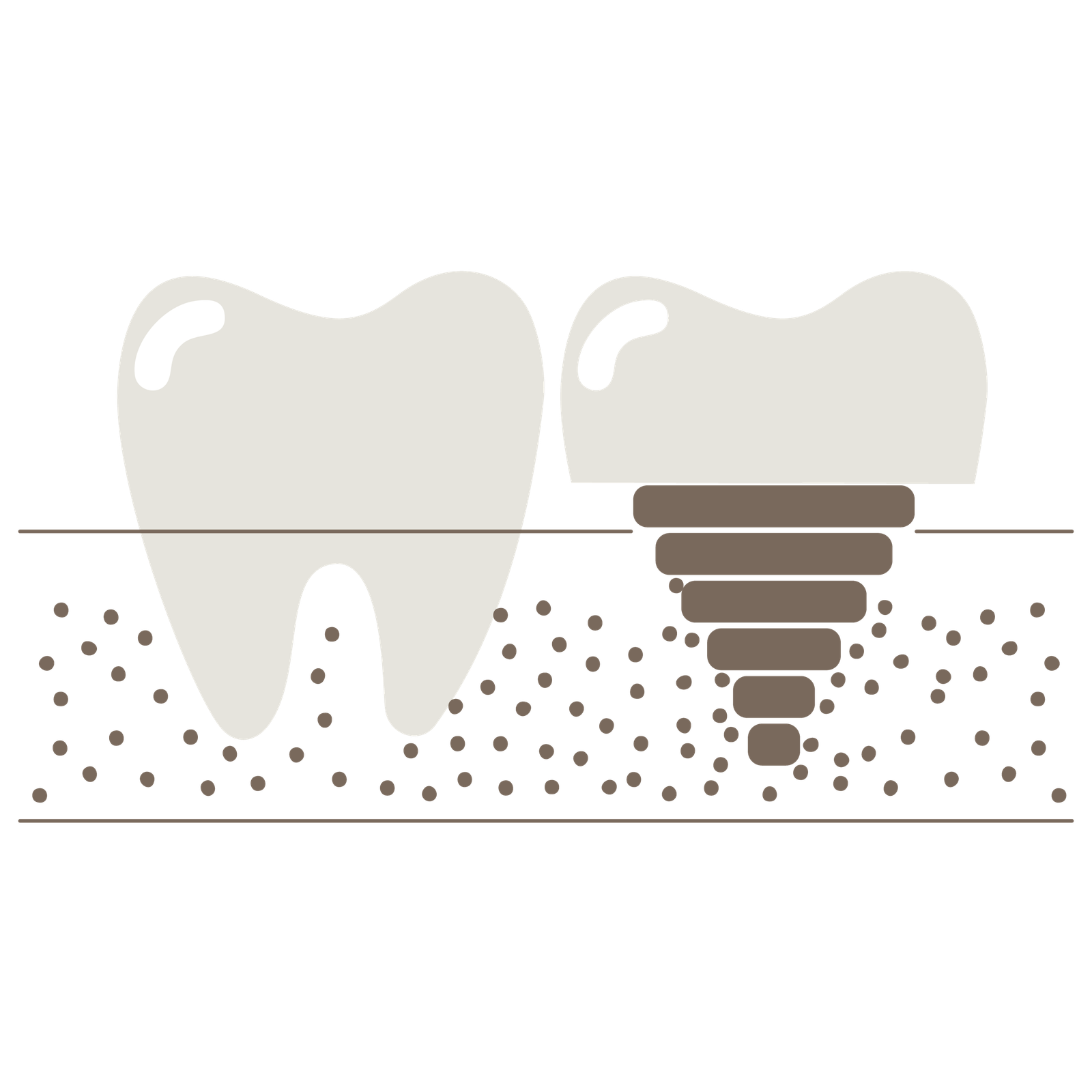 implants