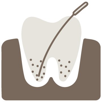 Root Canal